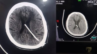 أول جراحة لتركيب صمام مخي بريتوني